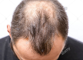Say goodbye to baldness: four tips to prevent hair loss
